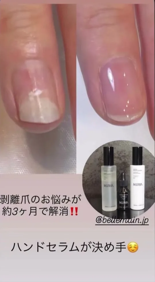 ベリュマン使用例 CASE 04（使用前・使用後）