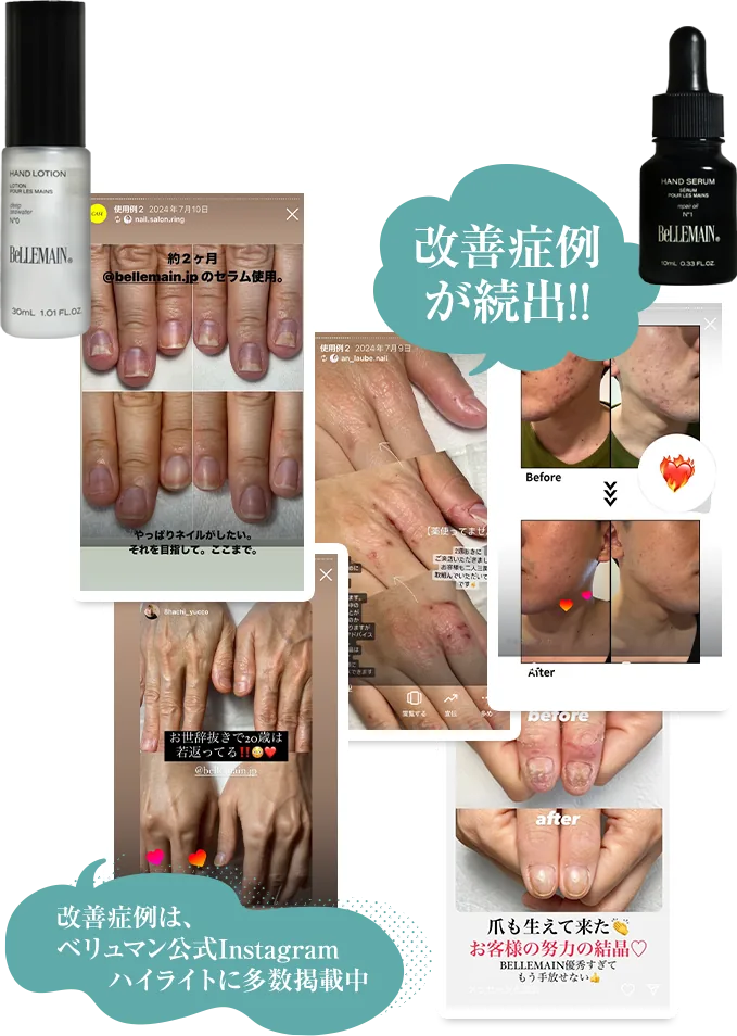 改善症例が続出!!改善症例は、ベリュマン公式Instagramハイライトに多数掲載中
